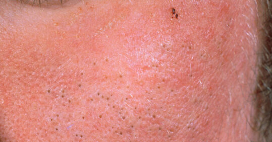 Picture quiz – types of acne