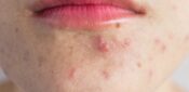 CPD learning module: managing acne in primary care