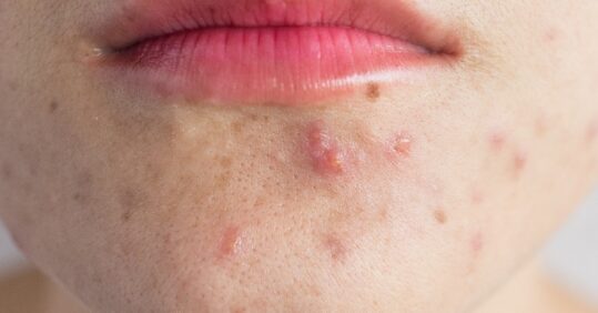 CPD learning module: managing acne in primary care