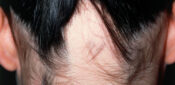 Picture quiz – causes of alopecia