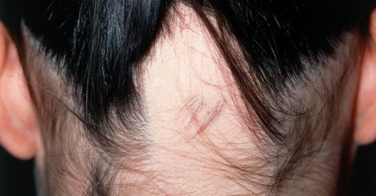 Picture quiz – causes of alopecia