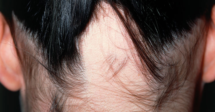 Severe hair loss treatment approved by MHRA