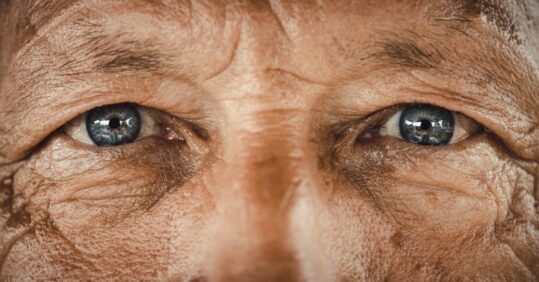 Eye conditions linked with increased risk of dementia, study finds