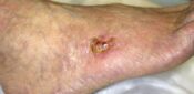 Ten top tips: lower limb wounds