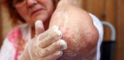 Patterns and trends in eczema management in primary care