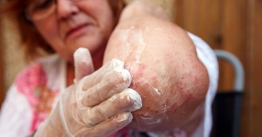 Patterns and trends in eczema management in primary care