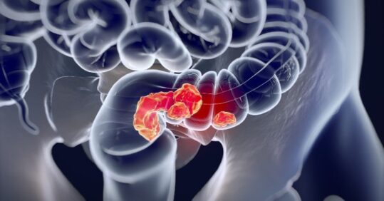 CPD module: Bowel cancer risks, identification and management