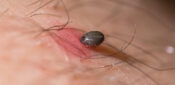 Ten top tips for nurses on Lyme disease