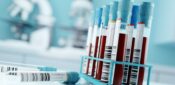 New blood test could help diagnose ovarian cancer faster