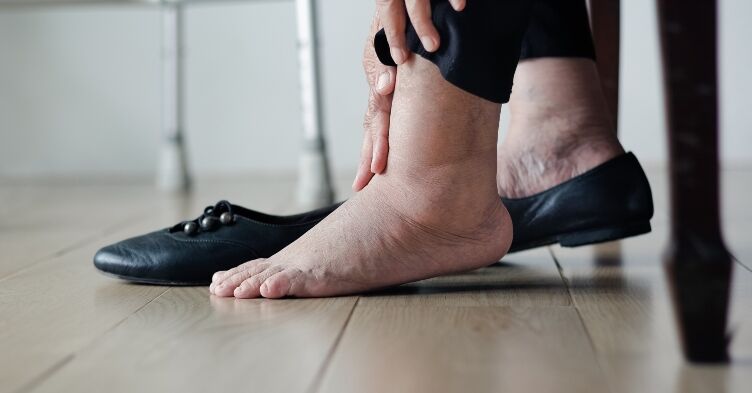 Diabetes patients ‘reliant on general practice’ as specialist footcare access patchy, warns review