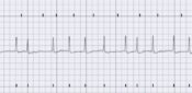 CPD: Improving detection and management of atrial fibrillation