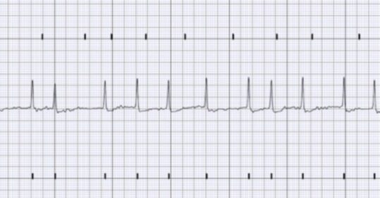 CPD: Improving detection and management of atrial fibrillation