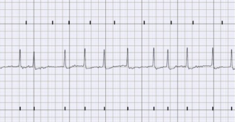 CPD: Improving detection and management of atrial fibrillation