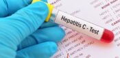 Cases of chronic hepatitis C fall ‘significantly’