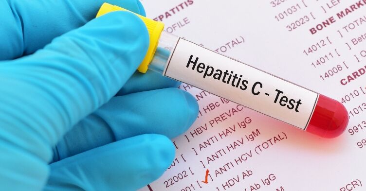 Cases of chronic hepatitis C fall ‘significantly’