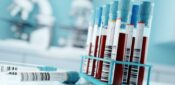 Over 100k volunteer to trial blood test that detects over 50 cancers