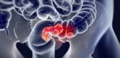 Bowel cancer screening extended to patients aged 58