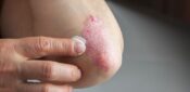 Psoriasis diagnoses in primary care delayed by up to five years, study shows