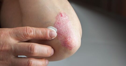 Psoriasis diagnoses in primary care delayed by up to five years, study shows