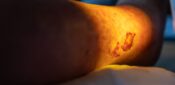 ‘Smart bandages’ could reduce antibiotic use for non-healing wounds