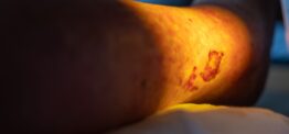 ‘Smart bandages’ could reduce antibiotic use for non-healing wounds