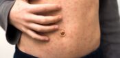 Risk of measles outbreak in London amid poor vaccination rates