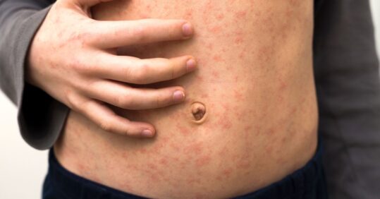 Risk of measles outbreak in London amid poor vaccination rates