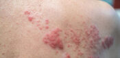 Understanding shingles and the extended vaccination campaign