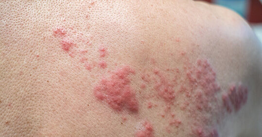 Understanding shingles and the extended vaccination campaign