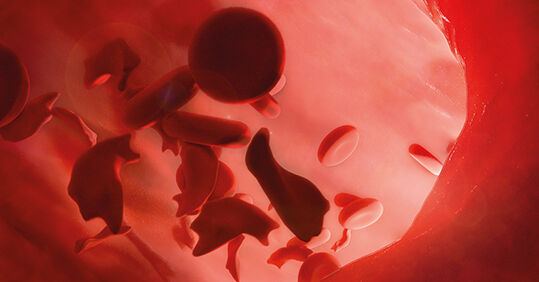 Q&A: Understanding sickle cell