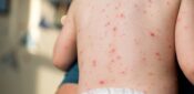 JCVI recommends chickenpox vaccine for all children