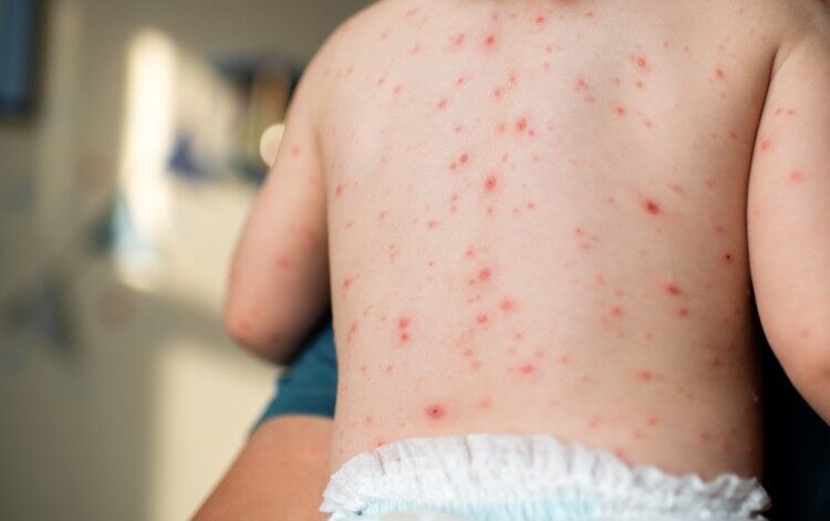 JCVI recommends chickenpox vaccine for all children