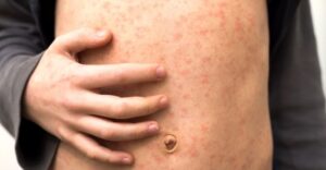 Measles-what-nurses-in-primary-care-need-to-know