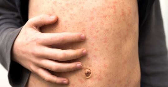 Measles: What nurses in primary care need to know