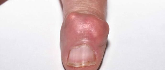 Gout increases the risk of multiple diseases