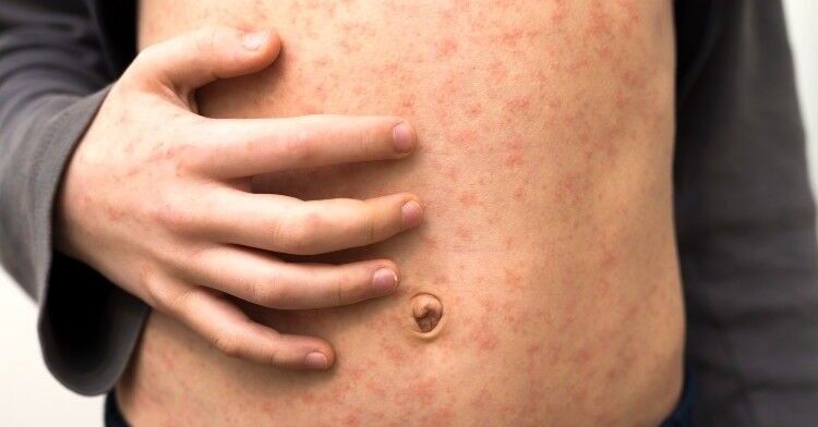 Measles cases in London now in line with West Midlands