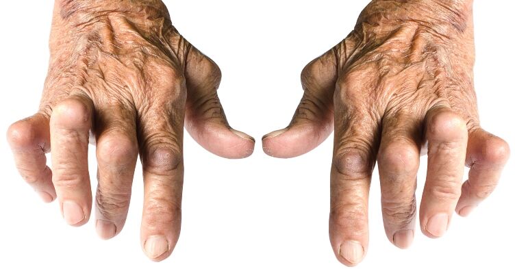 CPD: Reviewing patients with rheumatoid arthritis