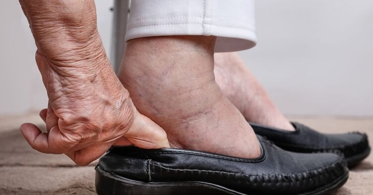 Mythbuster: ‘Her ankles are very swollen – she needs water tablets’