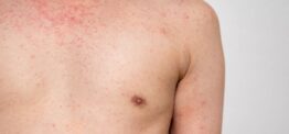 March sees highest number of measles cases yet as outbreak continues to spread