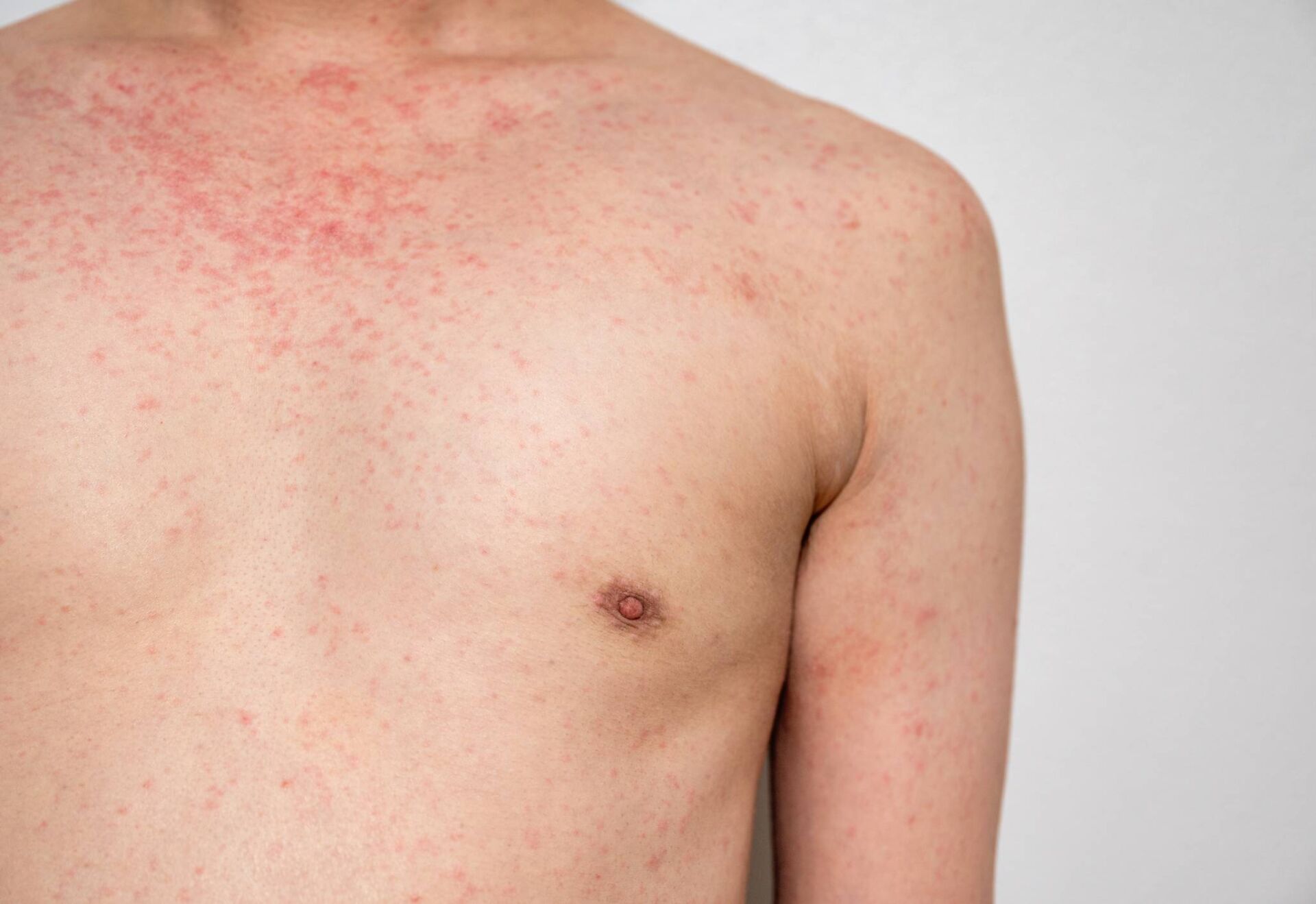 March sees highest number of measles cases yet as outbreak continues to spread