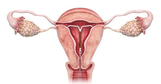 Supporting access to intrauterine contraception