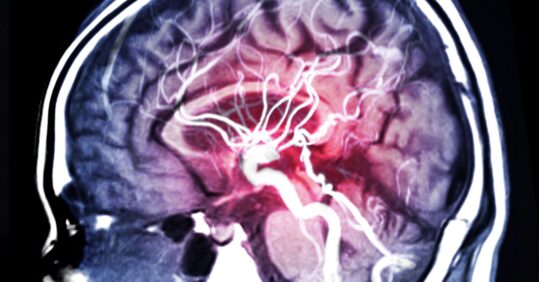 Study finds ‘clear correlation’ between AF and risk of vascular dementia