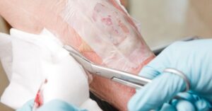 Larval therapy for wound management