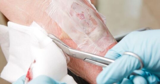 The role of larval therapy in wound care