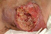 Larval debridement end