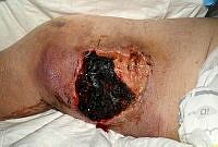 Larval therapy for traumatic wound - stage 1