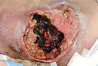 Larval debridement - stage 3