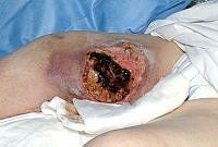 Larval debridement stage 3
