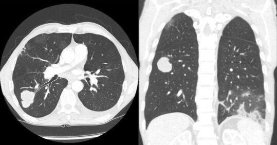 Supporting lung cancer screening in the community  