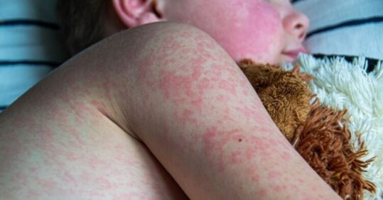 CPD: Case by case – measles and whooping cough